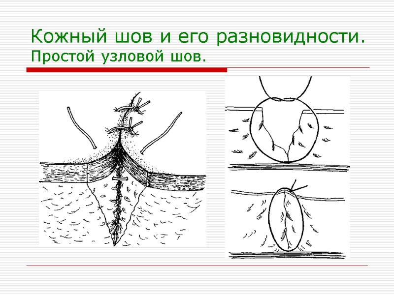 Кожный шов и его разновидности. Простой узловой шов.